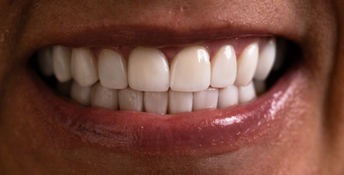 Smile Design Deisi Martinez After