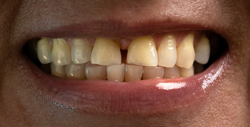 Smile Design Deisi Martinez Before