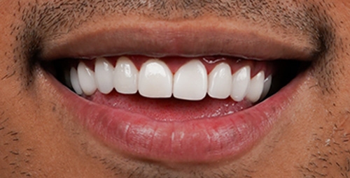 Smile Design felix After