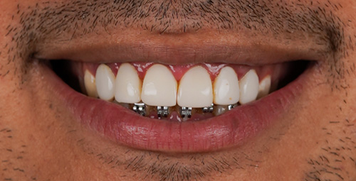 Smile Design felix Before