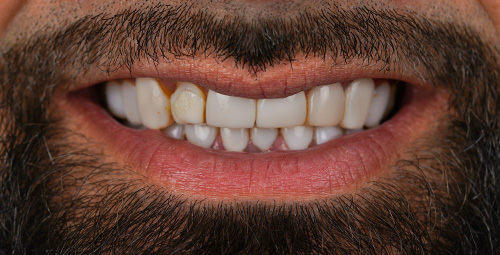 Smile Design Edwin Before