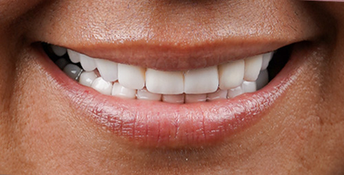 Smile Design Patient After