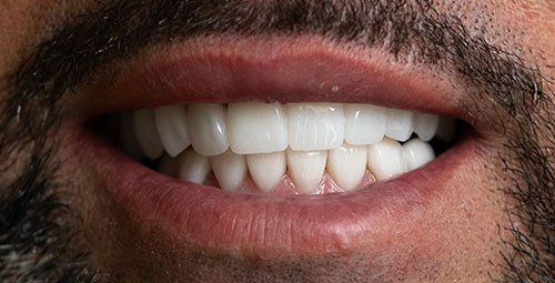 Smile Design Patient Alexandry Gonzalez After