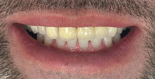 Smile Design Patient Alexandry Gonzalez Before