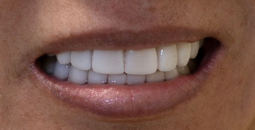 Smile Design Patient Araceli Vargas After