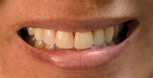 Smile Design Patient Araceli Vargas Before