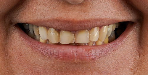 Smile Design Patient Before