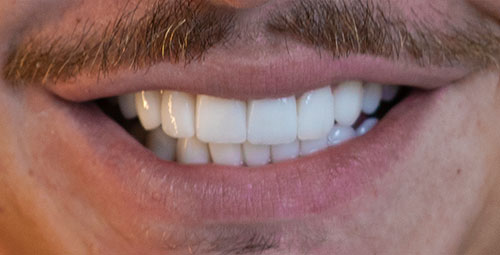 Paciente real tratado en Aria con diseño de sonrisa en Miami - foto del despues