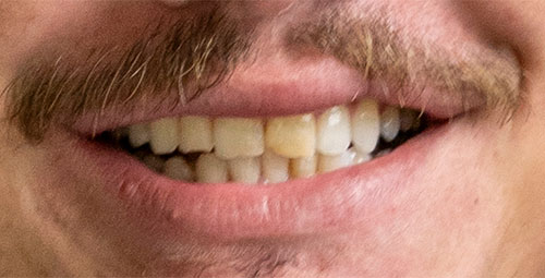 Smile Design Patient Brian Cordova Before