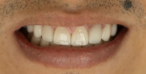 Smile Design Patient Camilo Tovar After