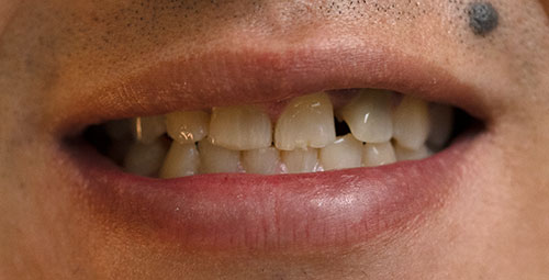 Smile Design Patient Camilo Tovar Before