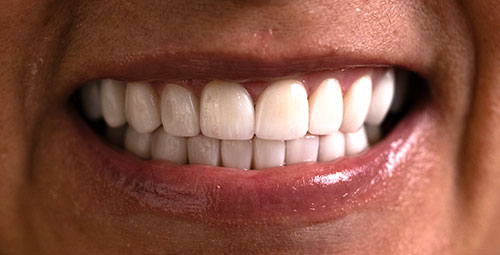 Smile Design Patient Deisi Martinez After
