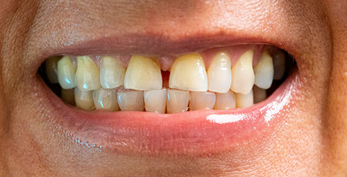 real patient smile design before