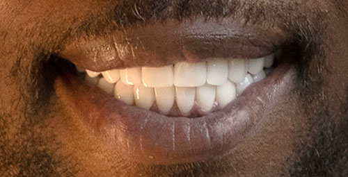 Smile Design Patient Denane Lloyd After