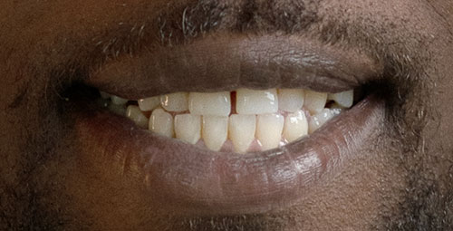 Smile Design Patient Denane Lloyd Before