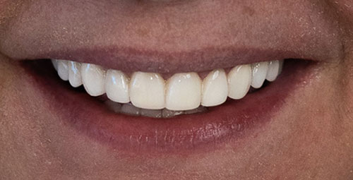 Smile Design Patient Doris Davila After