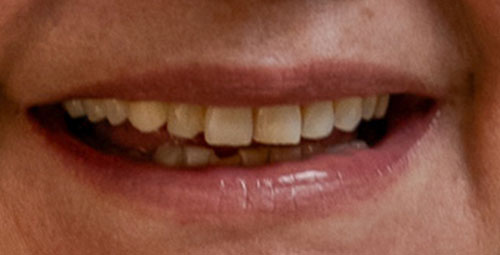 Smile Design Patient Doris Davila Before