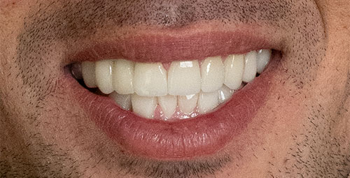 male smile design after