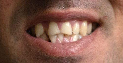 male smile design before