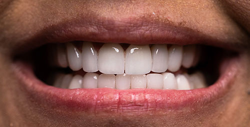 Smile Design Patient Eva Willis After