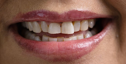 Smile Design Patient Eva Willis Before