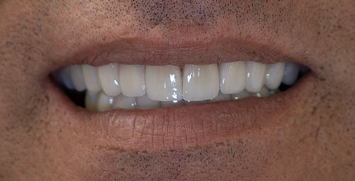 Smile Design Patient Jorge Hernandez After