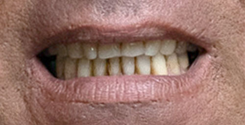 Smile Design Patient Jorge Hernandez Before