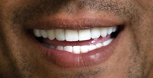 Smile Design Patient Jorge Urnbina After