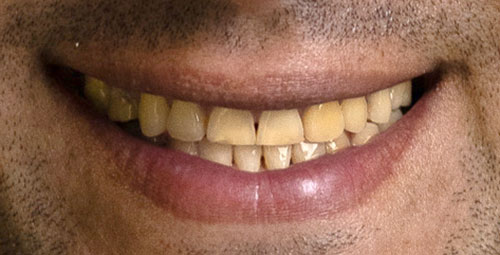 Smile Design Patient Jorge Urnbina Before