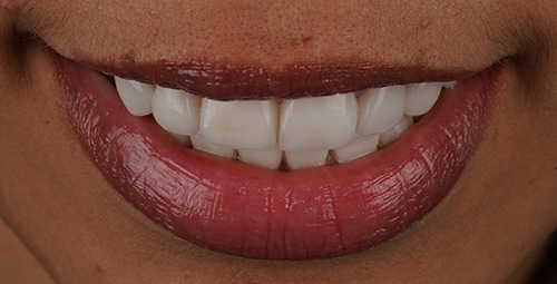 Smile Design Lianet After