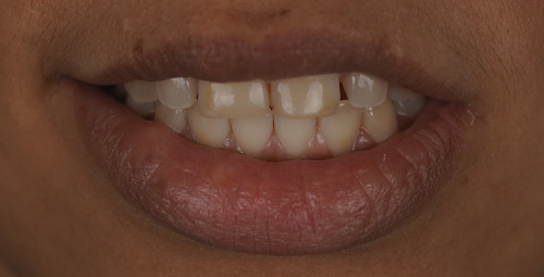 Smile Design Lianet Before