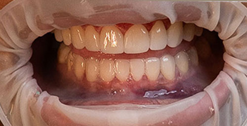Smile Design Patient maribel After
