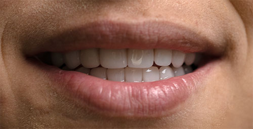 Smile Design Patient Maria Etere After