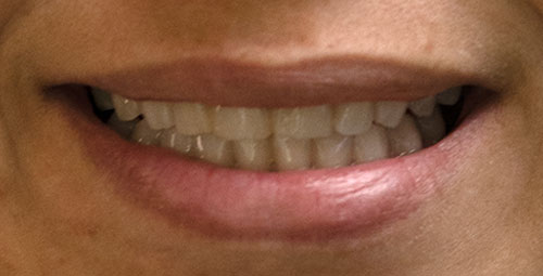 Smile Design Patient Maria Etere Before