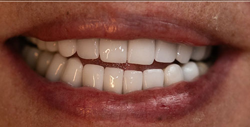 Smile Design Patient maribel After