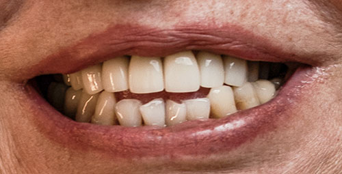 Smile Design Patient maribel Before