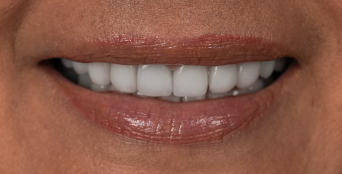 Smile Design Mariela After