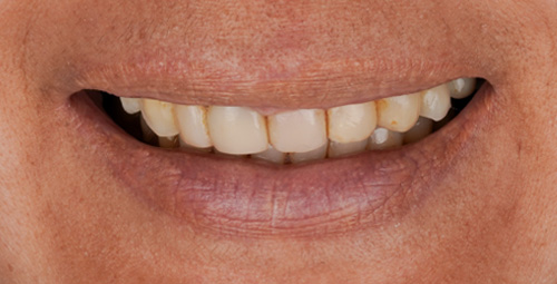 Smile Design Mariela Before