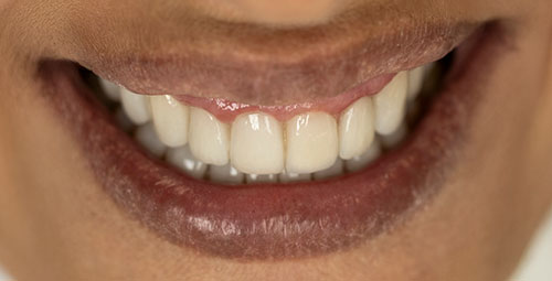 Smile Design Patient Marlena Hafferty After