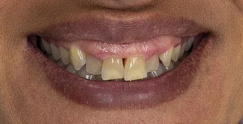 Smile Design Patient Marlena Hafferty Before