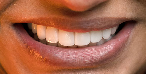 Smile Design Patient Mayrin Ledesma After