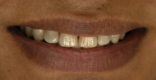 Smile Design Patient Mayrin Ledesma Before