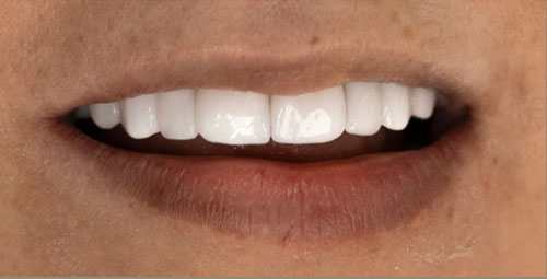 Smile Design Patient melanni mercado After