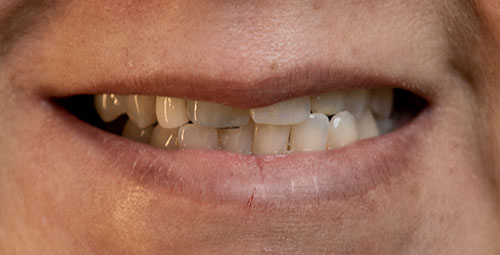 Smile Design Patient melanni mercado Before