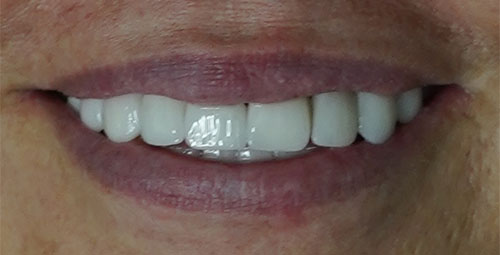 Smile Design Patient Millami Sanchez After