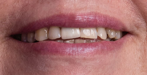 Smile Design Patient Millami Sanchez Before