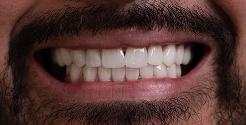 Smile Design Patient Nelson Torres After