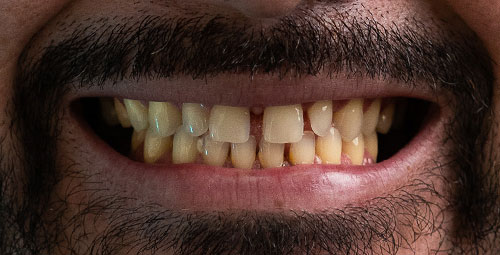 Smile Design Patient Nelson Torres Before