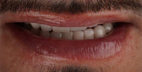 Smile Design Oscar After