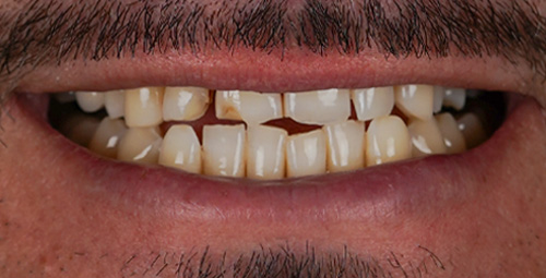 Smile Design Oscar Before